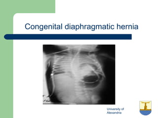 University of
Alexandria
Congenital diaphragmatic hernia
 