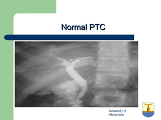 University of
Alexandria
Normal PTCNormal PTC
 