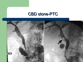 University of
Alexandria
CBD stone-PTCCBD stone-PTC
 