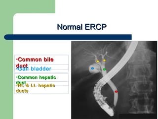 University of
Alexandria
Normal ERCPNormal ERCP
•Common bileCommon bile
ductduct
•Gall bladder
•Common hepaticCommon hepatic
ductduct
•Rt. & Lt. hepaticRt. & Lt. hepatic
ductsducts
 