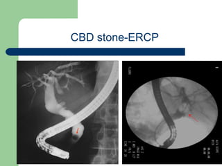 University of
Alexandria
CBD stone-ERCP
 