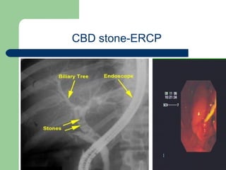 University of
Alexandria
CBD stone-ERCP
 