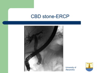 University of
Alexandria
CBD stone-ERCP
 