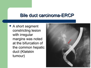 University of
Alexandria
Bile duct carcinoma-ERCPBile duct carcinoma-ERCP
 A short segment
constricting lesion
with irregular
margins was noted
at the bifurcation of
the common hepatic
duct (Klatskin
tumour)
 