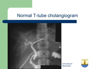 University of
Alexandria
Normal T-tube cholangiogram
 