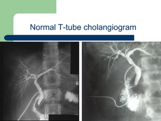 University of
Alexandria
Normal T-tube cholangiogram
 