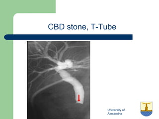 University of
Alexandria
CBD stone, T-Tube
 