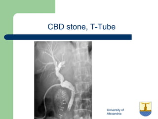 University of
Alexandria
CBD stone, T-Tube
 