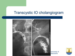 University of
Alexandria
Transcystic IO cholangiogram
 