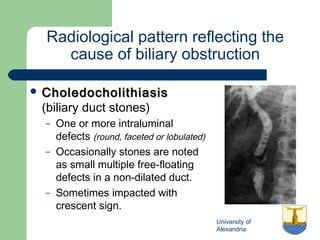 University of
Alexandria
Radiological pattern reflecting the
cause of biliary obstruction
 CholedocholithiasisCholedocholithiasis
(biliary duct stones)
– One or more intraluminal
defects (round, faceted or lobulated)
– Occasionally stones are noted
as small multiple free-floating
defects in a non-dilated duct.
– Sometimes impacted with
crescent sign.
 