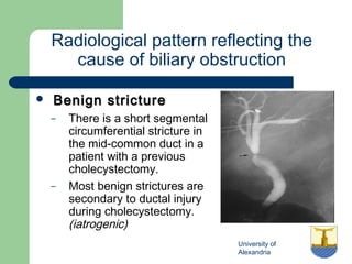 University of
Alexandria
Radiological pattern reflecting the
cause of biliary obstruction
 Benign strictureBenign stricture
– There is a short segmental
circumferential stricture in
the mid-common duct in a
patient with a previous
cholecystectomy.
– Most benign strictures are
secondary to ductal injury
during cholecystectomy.
(iatrogenic)
 
