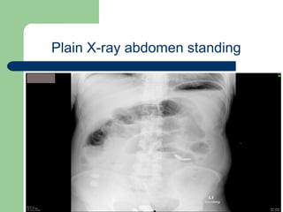 University of
Alexandria
Plain X-ray abdomen standing
 