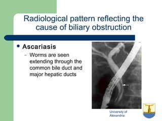 University of
Alexandria
Radiological pattern reflecting the
cause of biliary obstruction
 Ascariasis
– Worms are seen
extending through the
common bile duct and
major hepatic ducts
 