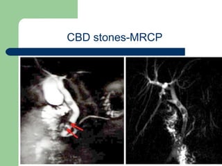 University of
Alexandria
CBD stones-MRCP
 