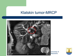 University of
Alexandria
Klatskin tumor-MRCP
 