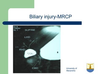 University of
Alexandria
Biliary injury-MRCP
 