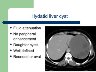 University of
Alexandria
Hydatid liver cyst
 Fluid attenuation
 No peripheral
enhancement
 Daughter cysts
 Well defined
 Rounded or oval
 