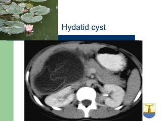University of
Alexandria
Hydatid cyst
 
