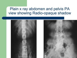 University of
Alexandria
Plain x ray abdomen and pelvis PA
view showing Radio-opaque shadow
 