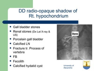 University of
Alexandria
DD radio-opaque shadow of
Rt. hypochondrium
 Gall bladder stones
 Renal stones (Dx Lat X-ray &
US)
 Porcelain gall bladder
 Calcified LN
 Fracture tr. Process of
vertebra
 FB
 Fecolith
 Calcified hydatid cyst
 