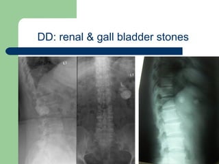 University of
Alexandria
DD: renal & gall bladder stones
 