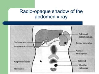 University of
Alexandria
Radio-opaque shadow of the
abdomen x ray
 