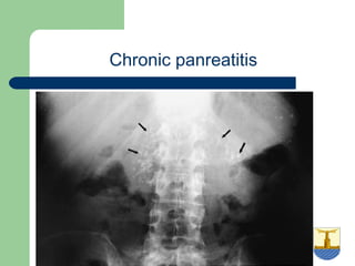 University of
Alexandria
Chronic panreatitis
 