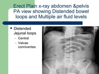 University of
Alexandria
Erect Plain x-ray abdomen &pelvis
PA view showing Distended bowel
loops and Multiple air fluid levels
 Distended
Jejunal loops
– Central
– Valvae
conniventes
 