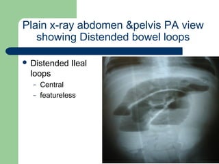 University of
Alexandria
Plain x-ray abdomen &pelvis PA view
showing Distended bowel loops
 Distended Ileal
loops
– Central
– featureless
 