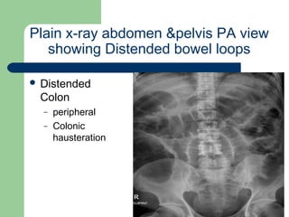 University of
Alexandria
Plain x-ray abdomen &pelvis PA view
showing Distended bowel loops
 Distended
Colon
– peripheral
– Colonic
hausteration
 