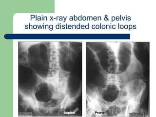 University of
Alexandria
Plain x-ray abdomen & pelvis
showing distended colonic loops
 