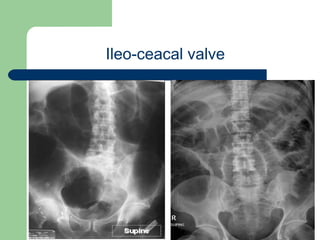 University of
Alexandria
Ileo-ceacal valve
 