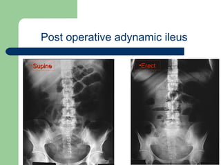 University of
Alexandria
Post operative adynamic ileus
•SupineSupine •ErectErect
 