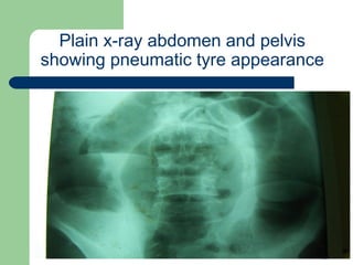 University of
Alexandria
Plain x-ray abdomen and pelvis
showing pneumatic tyre appearance
 