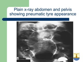 University of
Alexandria
Plain x-ray abdomen and pelvis
showing pneumatic tyre appearance
 