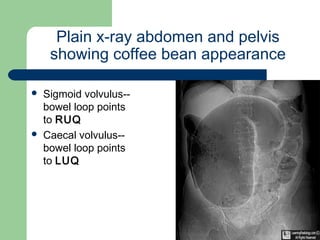 University of
Alexandria
Plain x-ray abdomen and pelvis
showing coffee bean appearance
 Sigmoid volvulus--
bowel loop points
to RUQ
 Caecal volvulus--
bowel loop points
to LUQ 
 