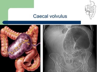 University of
Alexandria
Caecal volvulus
 
