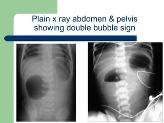 University of
Alexandria
Plain x ray abdomen & pelvis
showing double bubble sign
 