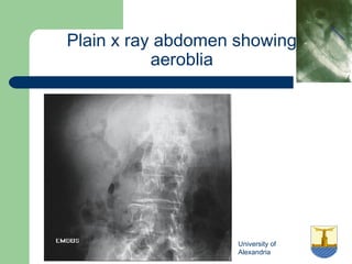 University of
Alexandria
Plain x ray abdomen showing
aeroblia
 