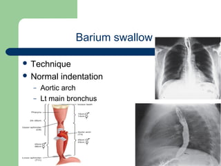 University of
Alexandria
Barium swallow
 Technique
 Normal indentation
– Aortic arch
– Lt main bronchus
 