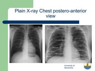 University of
Alexandria
Plain X-ray Chest postero-anterior
view
 