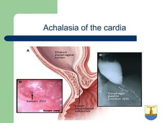 University of
Alexandria
Achalasia of the cardia
 