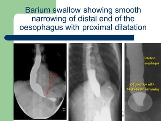University of
Alexandria
Barium swallow showing smooth
narrowing of distal end of the
oesophagus with proximal dilatation
 