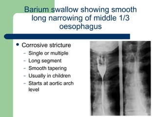 University of
Alexandria
Barium swallow showing smooth
long narrowing of middle 1/3
oesophagus
 Corrosive stricture
– Single or multiple
– Long segment
– Smooth tapering
– Usually in children
– Starts at aortic arch
level
 