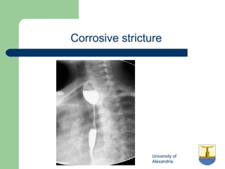 University of
Alexandria
Corrosive stricture
 