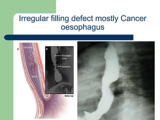 University of
Alexandria
Irregular filling defect mostly Cancer
oesophagus
 