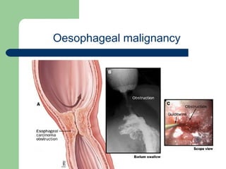 University of
Alexandria
Oesophageal malignancy
 