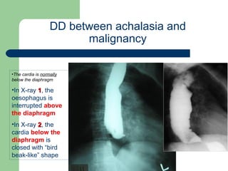 University of
Alexandria
DD between achalasia and
malignancy
•The cardia is normally
below the diaphragm
•In X-ray 11, the
oesophagus is
interrupted above
the diaphragm
•In X-ray 22, the
cardia below the
diaphragm is
closed with “bird
beak-like” shape
 
