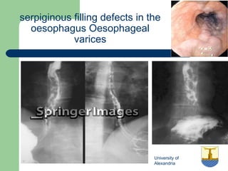 University of
Alexandria
serpiginous filling defects in the
oesophagus Oesophageal
varices
 