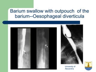 University of
Alexandria
Barium swallow with outpouch of the
barium--Oesophageal diverticula
 